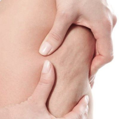 Despídete de la Celulitis Descubre el Efecto Fat Burner de Montibello